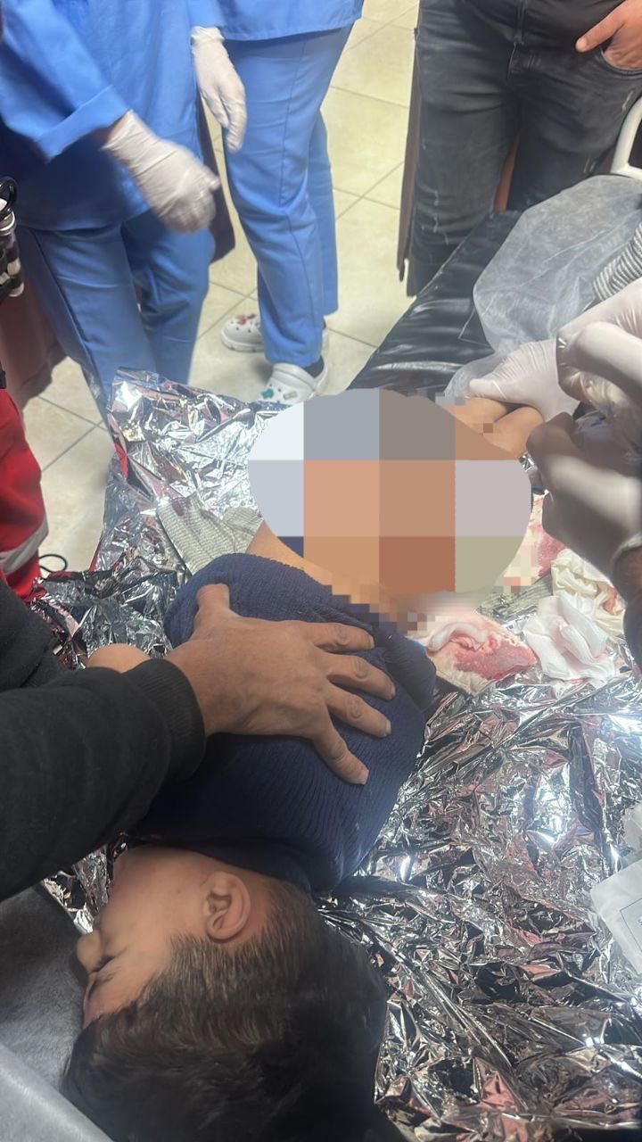 الطفل المصاب في مخيم بلاطة بعد أن هاجمه أحد كلاب الاحتلال.